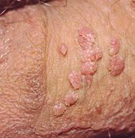 Male genital warts